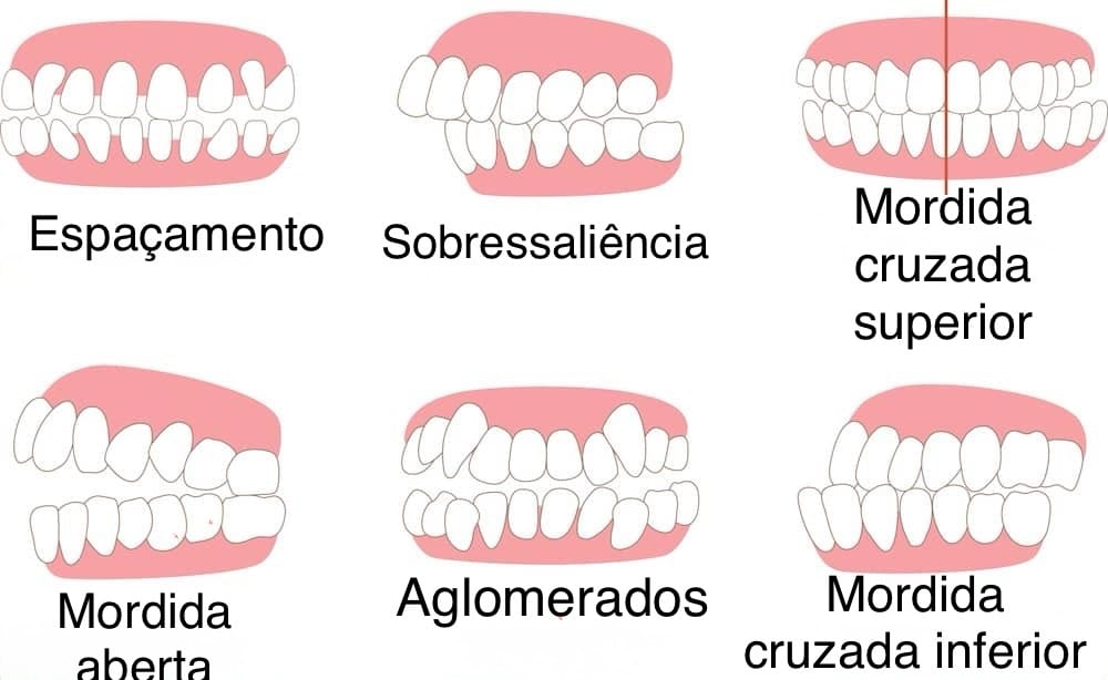 Chupetas podem causar atraso na fala? Bebê com chupeta.