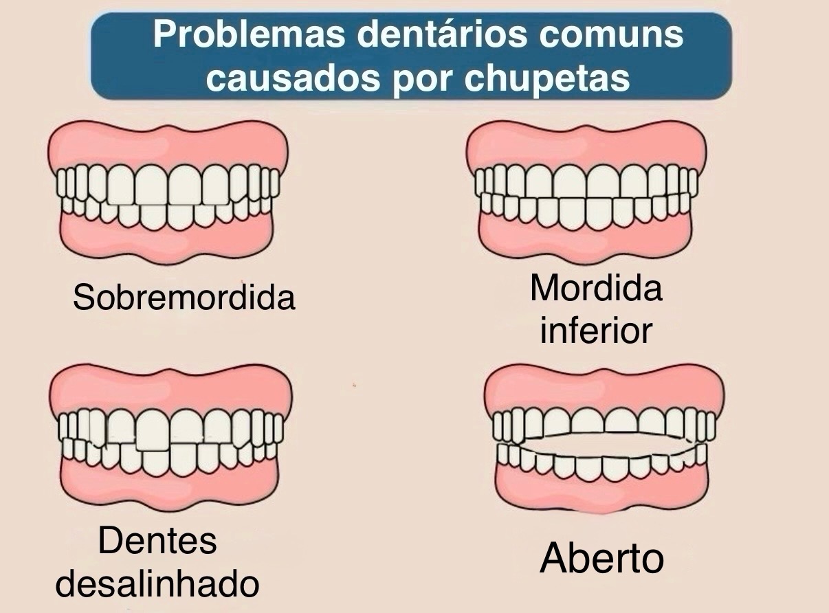Danos causados pela chupeta